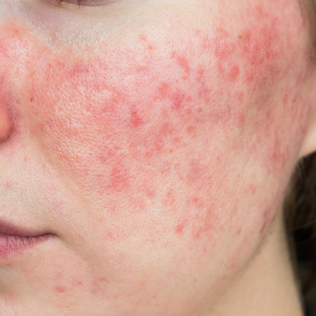 Woman with rosacea on the face