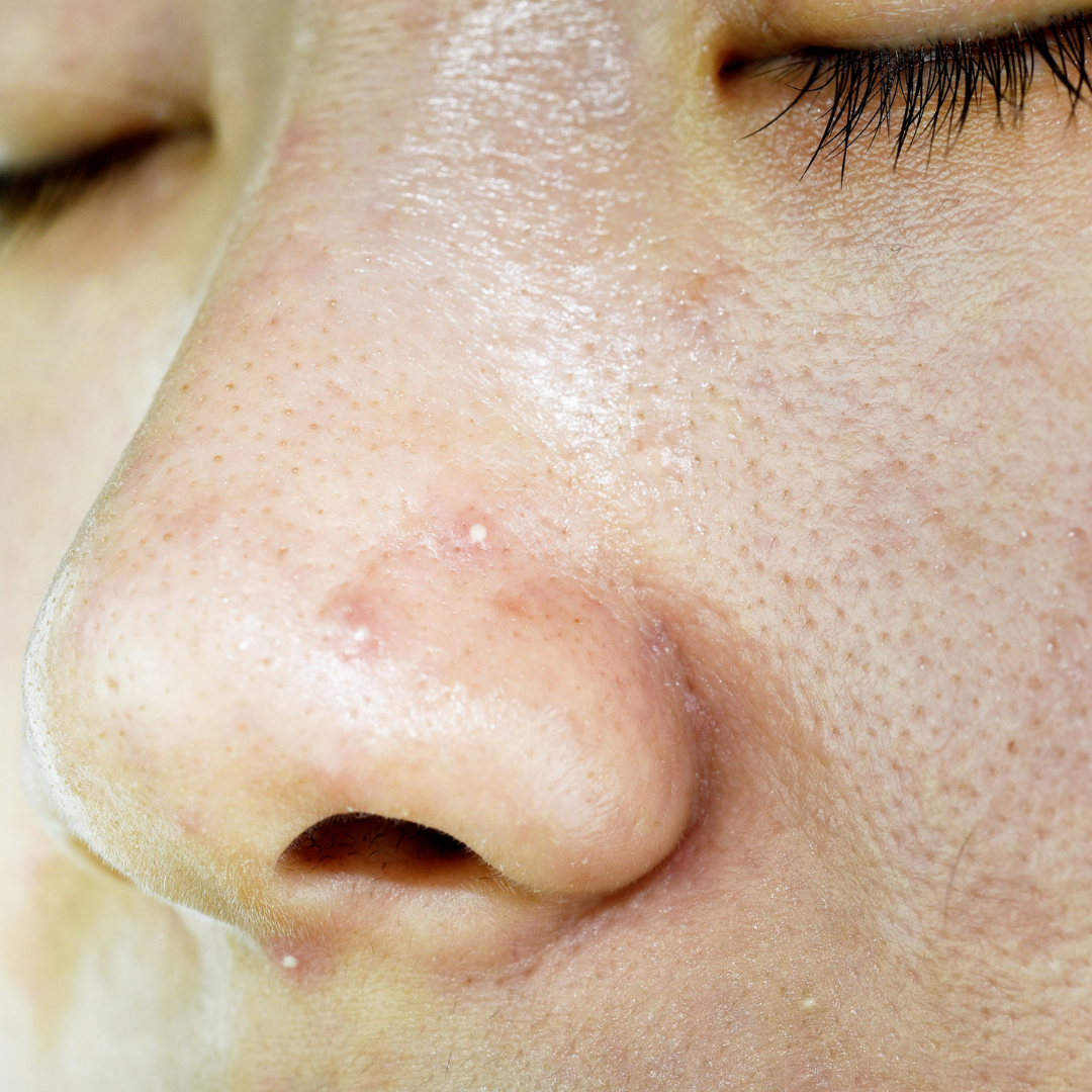 Nose and cheek area of someone with oily skin, large pores and small white heads.