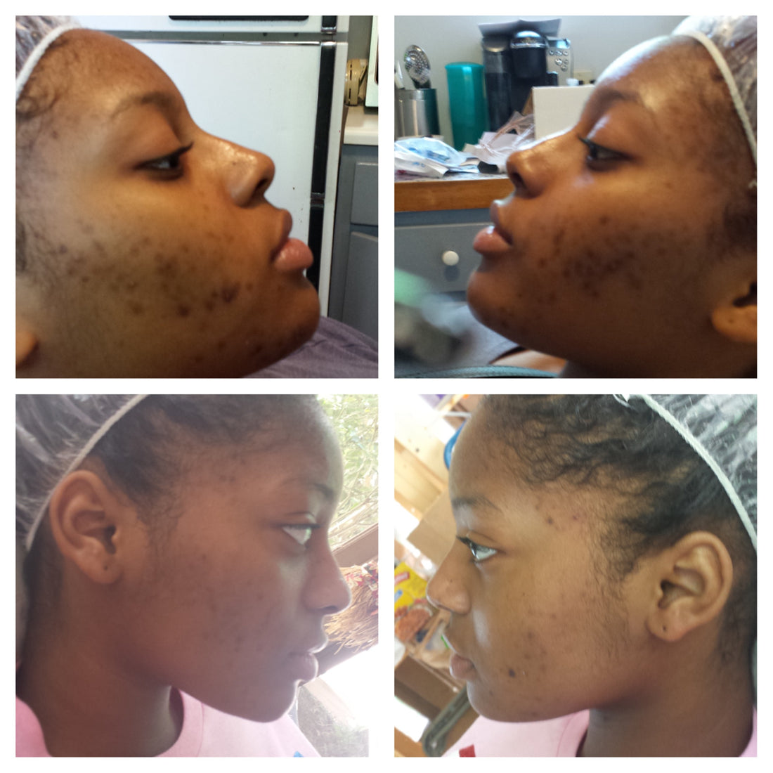 Three Things You Can Do To Get Rid Of Dark Spots