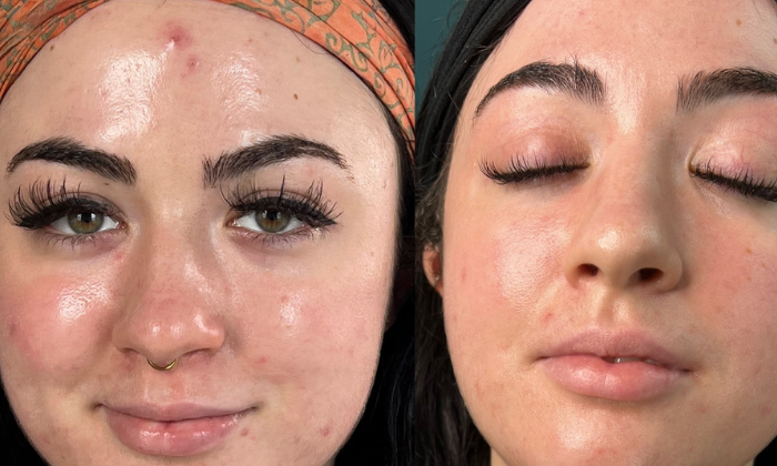 Virtual Skincare Consultation